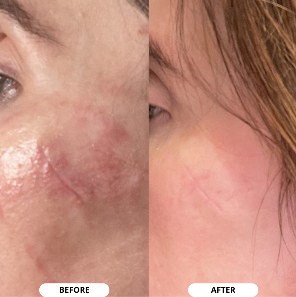 NEOCOLLAGEN™ Silicone Scar Sheets