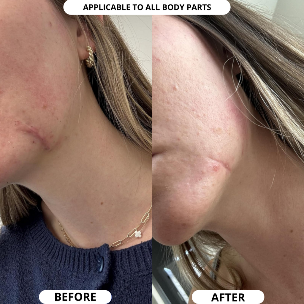 NEOCOLLAGEN™ Silicone Scar Sheets